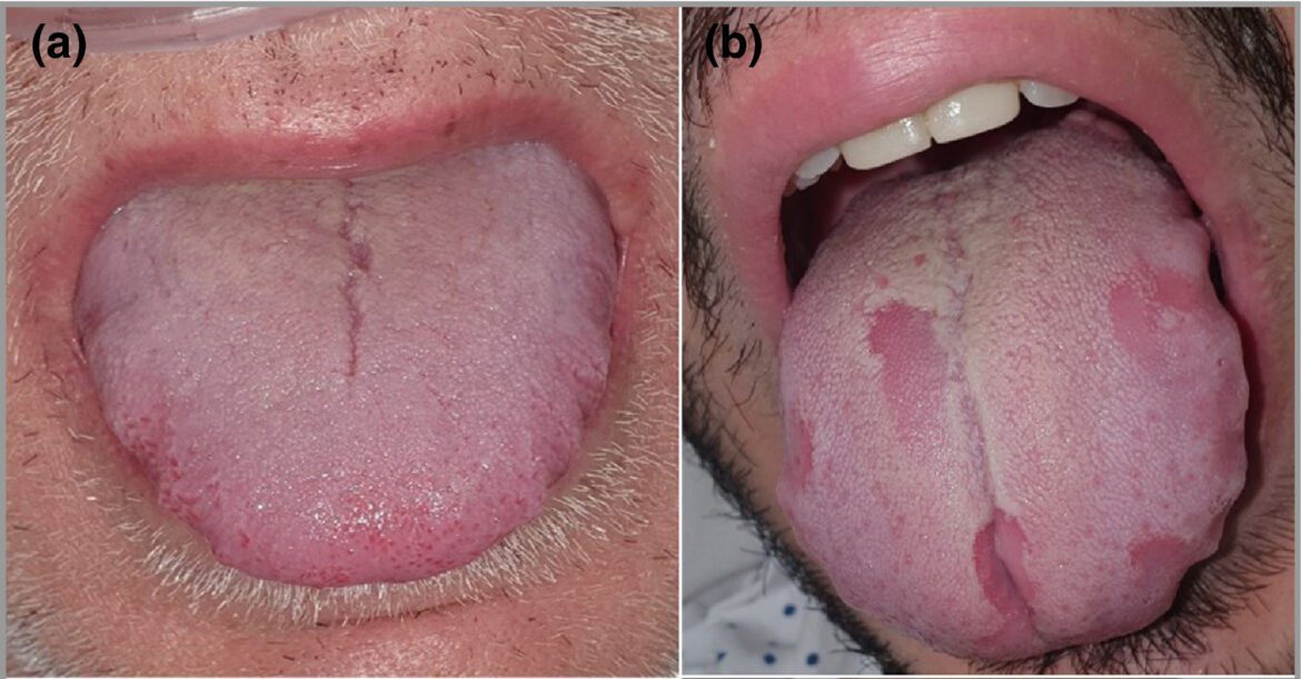 La Lengua Hinchada O Irregular Puede Ser Otro S Ntoma De COVID 19   Covid Tongue 1170x611 