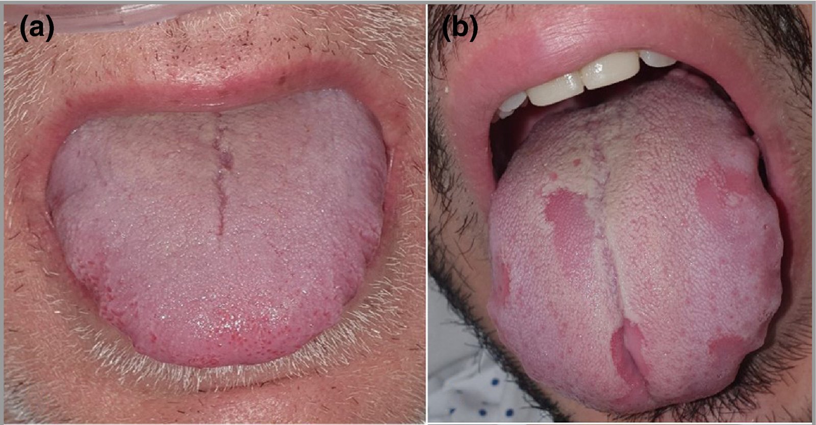 La lengua hinchada o irregular puede ser otro síntoma de COVID-19